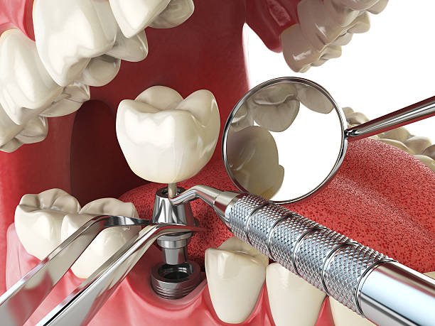 Best Urgent Care for Lost Fillings or Crowns in Fuquay Varina, NC